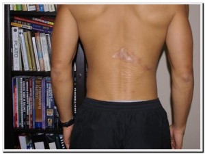 back scar