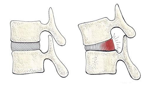 Spine When Squatting Spine When Squatting