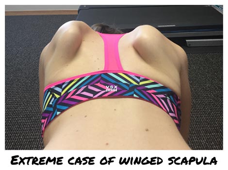 winged scapula